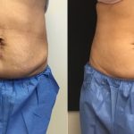 An Introduction to Fat Loss Treatment Coolsculpting