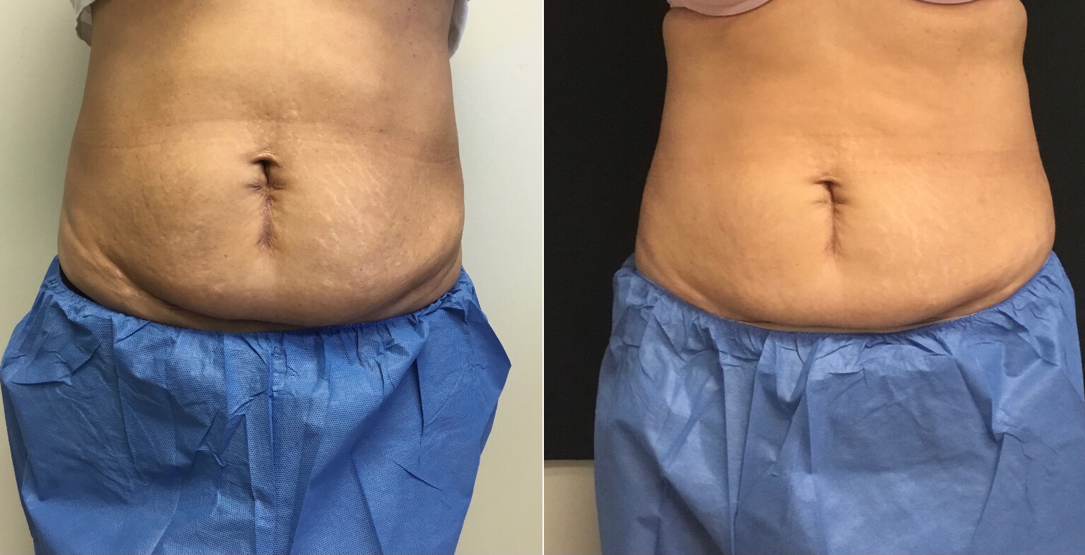 An Introduction to Fat Loss Treatment Coolsculpting